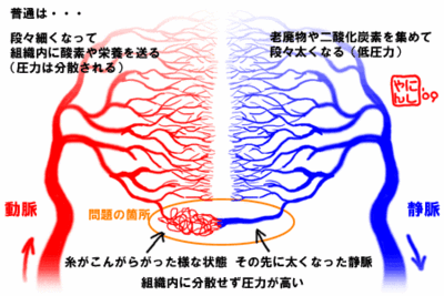 肺動静脈奇形