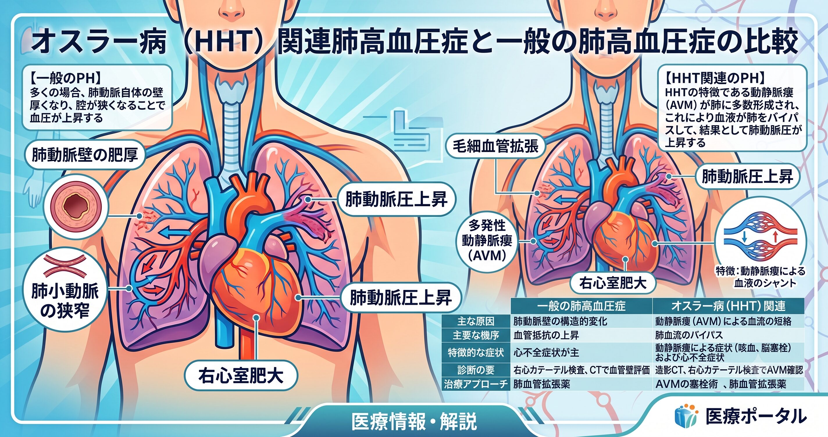 肺高血圧症（PH）とオスラー病の肝血管奇形による肺高血圧症の違いに